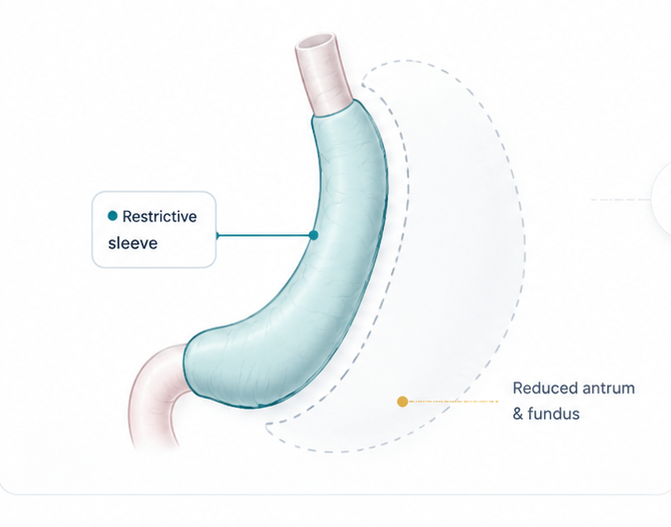 Standard sleeve gastrectomy — approximately 75–80% of the stomach is removed, leaving a narrow restrictive sleeve.