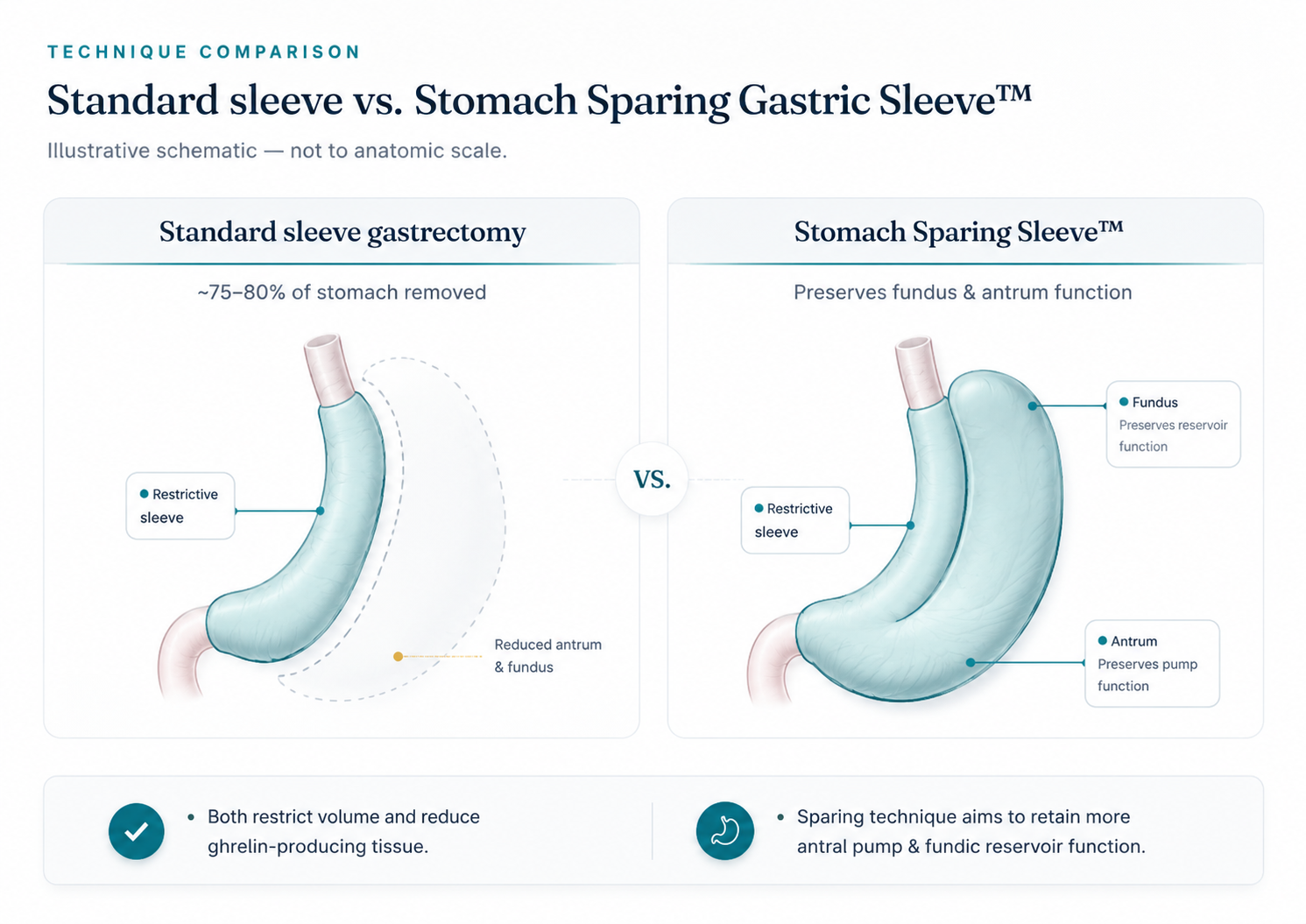 Technique comparison: standard sleeve gastrectomy versus Stomach Sparing Gastric Sleeve™ by Dr. Ariel Ortiz Lagardere — illustrative schematic showing preserved fundus and antrum function.