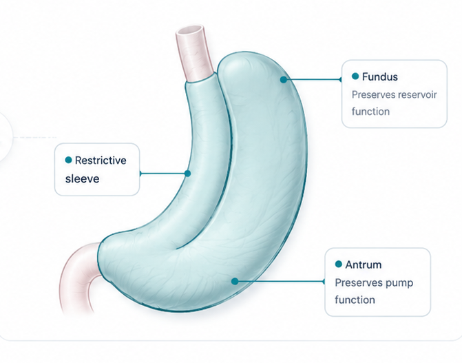Stomach Sparing Gastric Sleeve™ by Dr. Ariel Ortiz — preserves the fundus reservoir and antrum pump while creating a restrictive sleeve.